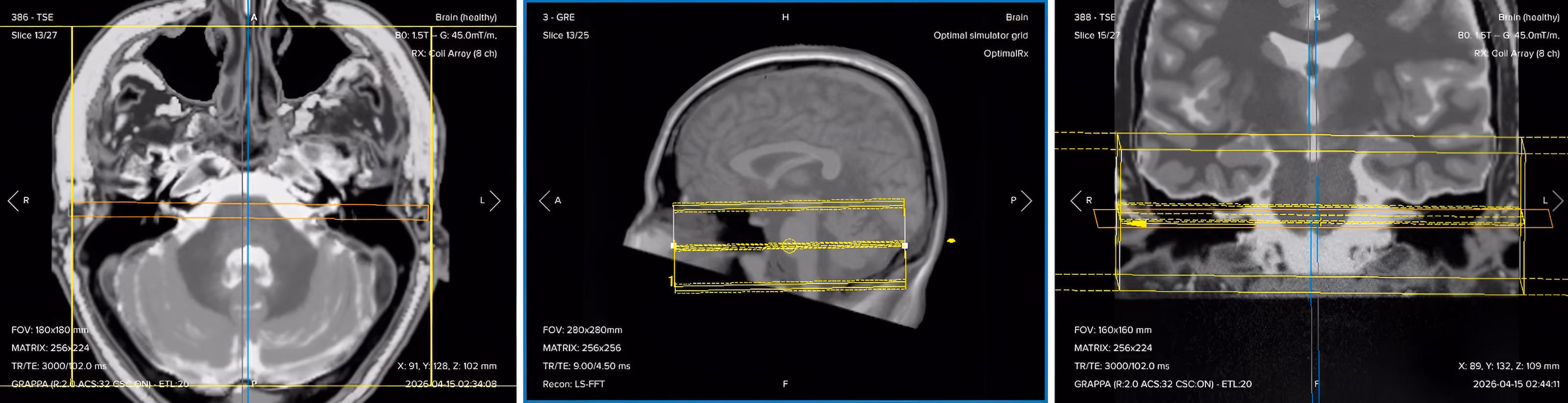 Correct planning of 3D axial bSSFP (CISS/FIESTA) for an IAC/IAM MRI protocol