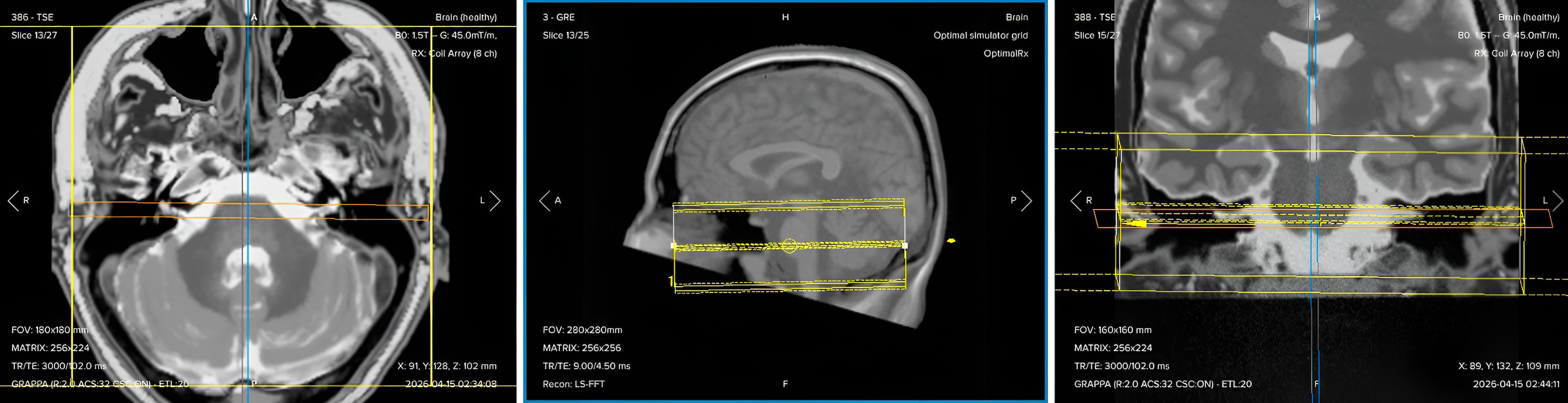 Correct planning of 3D axial bSSFP (CISS/FIESTA-C) for an IAC/IAM MRI protocol