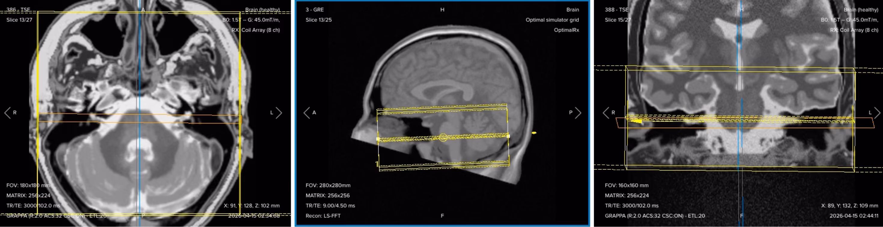 Correct planning of 3D axial T2 TSE (SPACE/CUBE) for an IAC/IAM MRI protocol