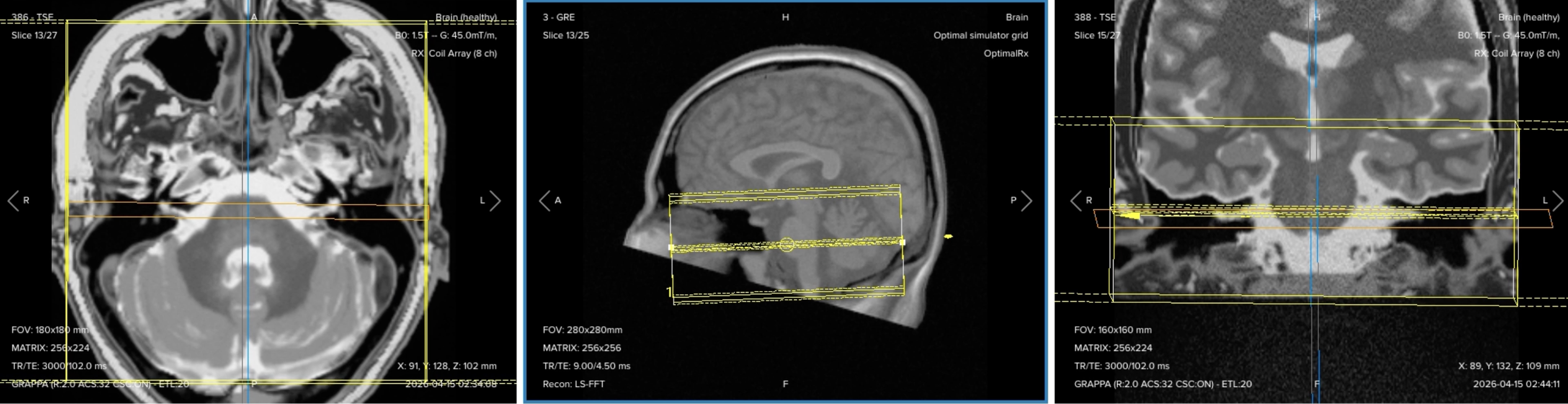 Correct planning of 3D axial T2 TSE (SPACE/CUBE) for an IAC/IAM MRI protocol