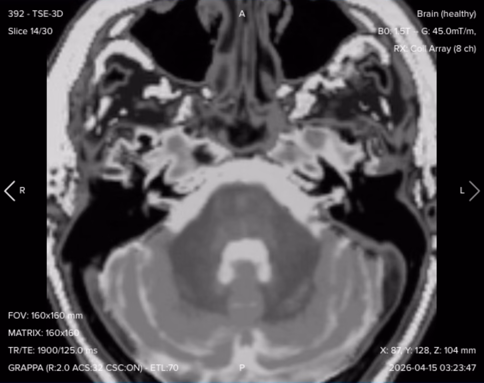 3D axial T2 TSE (SPACE/CUBE) image of the internal auditory canal with 1 mm isotropic resolution