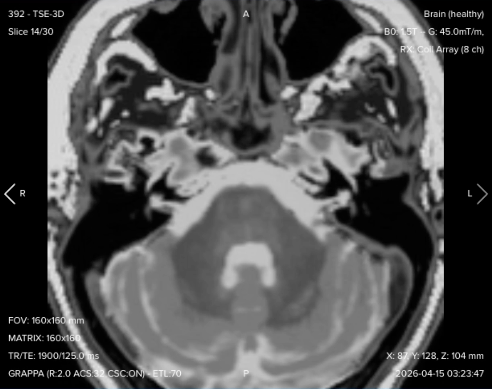 3D axial T2 TSE (SPACE/CUBE) image of the internal auditory canal with 1 mm isotropic resolution