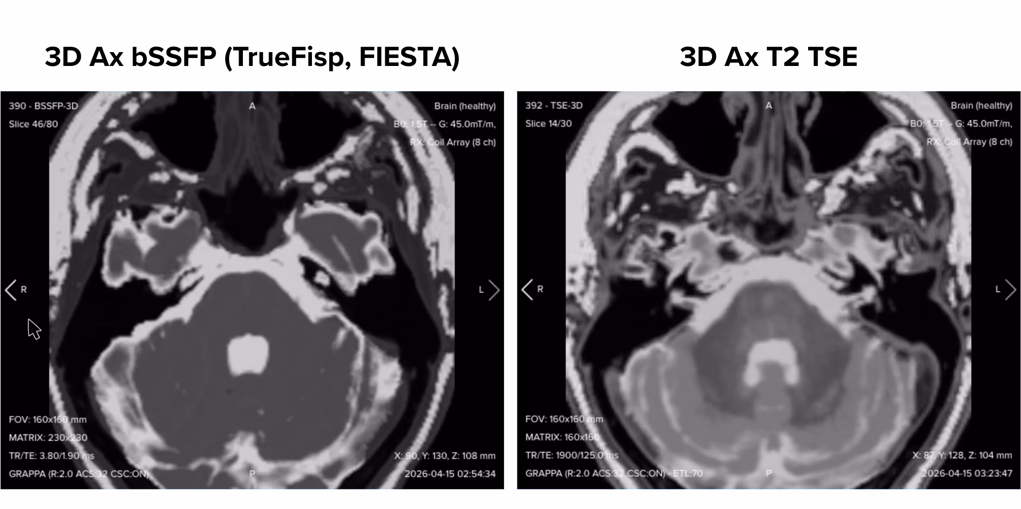 Side-by-side comparison of the 3D bSSFP and the 3D T2 TSE at the same slice level