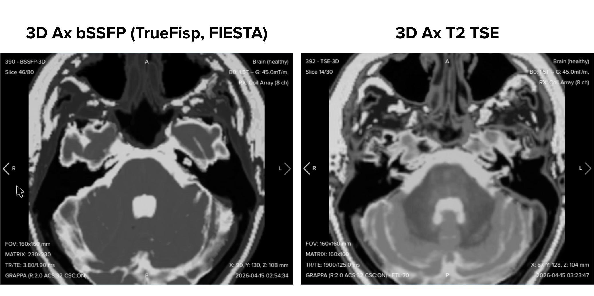 Side-by-side comparison of the 3D bSSFP and the 3D T2 TSE at the same slice level