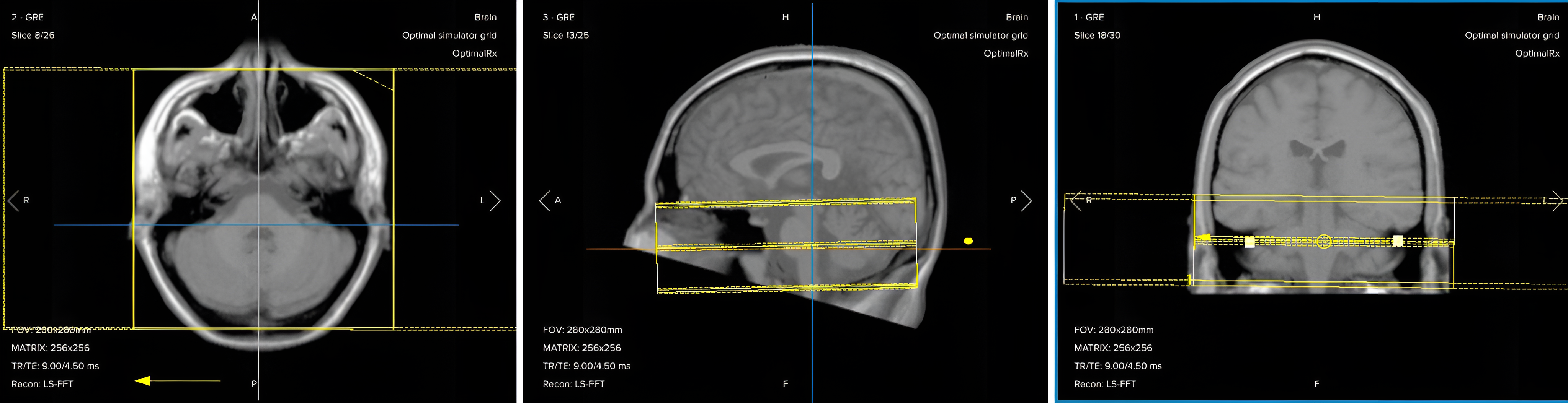 Correct planning of post-contrast axial T1 fat-suppressed TSE for an IAC/IAM MRI protocol