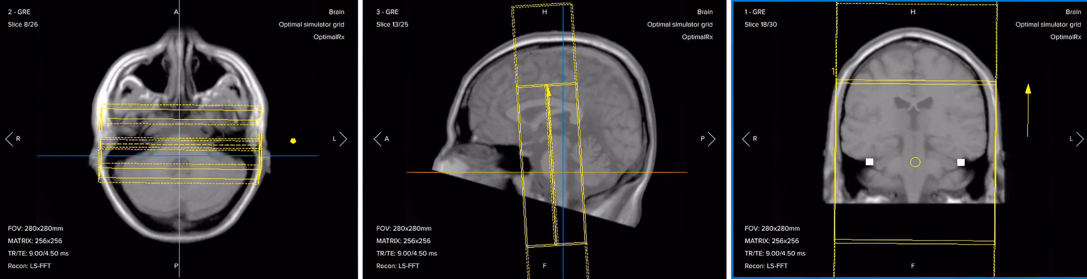 Correct planning of post-contrast coronal T1 fat-suppressed TSE for an IAC/IAM MRI protocol