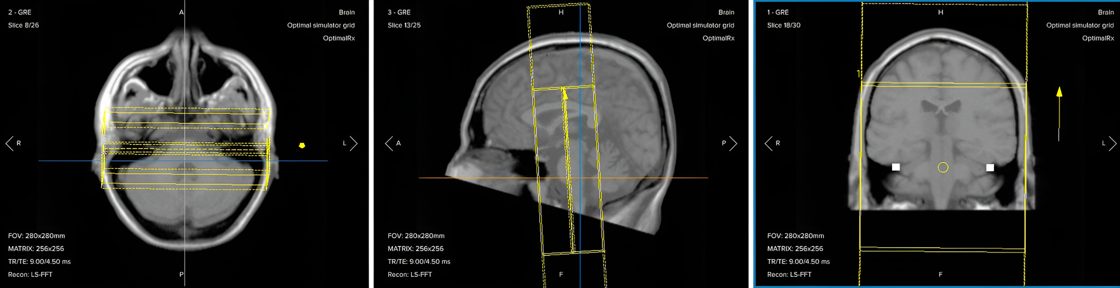 Correct planning of post-contrast coronal T1 fat-suppressed TSE for an IAC/IAM MRI protocol