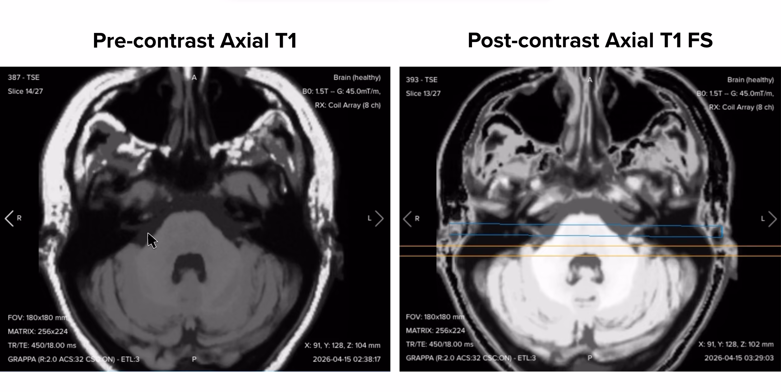 Comparison of pre-contrast axial T1 and post-contrast fat-suppressed axial T1 at the same slice position in an IAC MRI