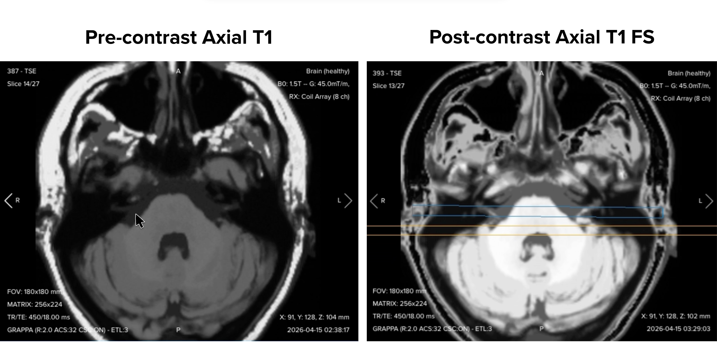 Comparison of pre-contrast axial T1 and post-contrast fat-suppressed axial T1 at the same slice position in an IAC MRI
