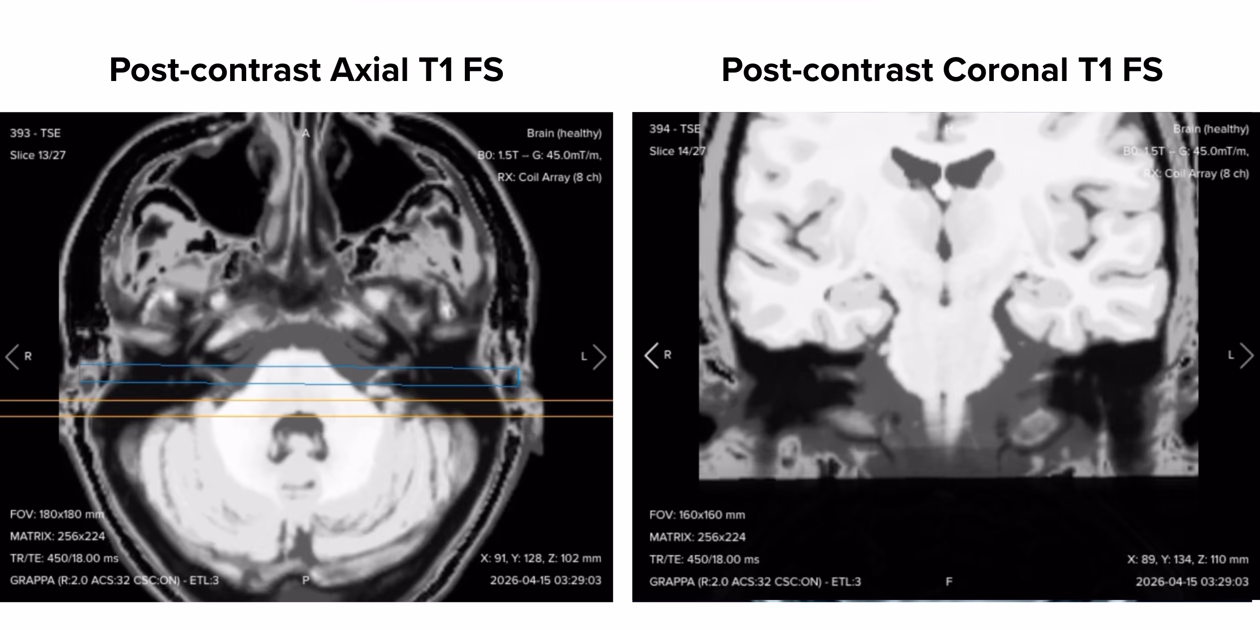 Post-contrast axial and coronal T1 fat-suppressed images of the IAC side by side