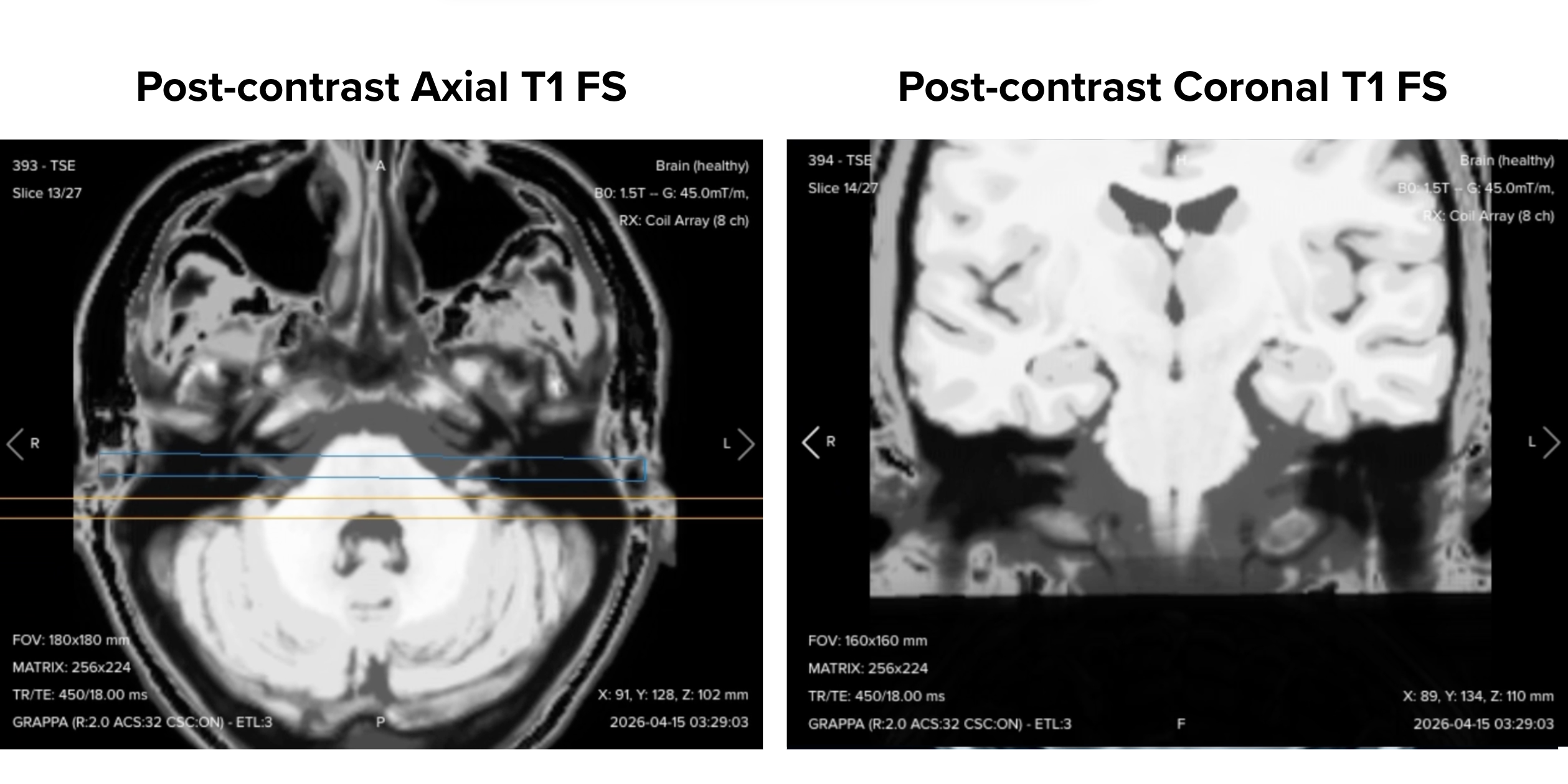 Post-contrast axial and coronal T1 fat-suppressed images of the IAC side by side