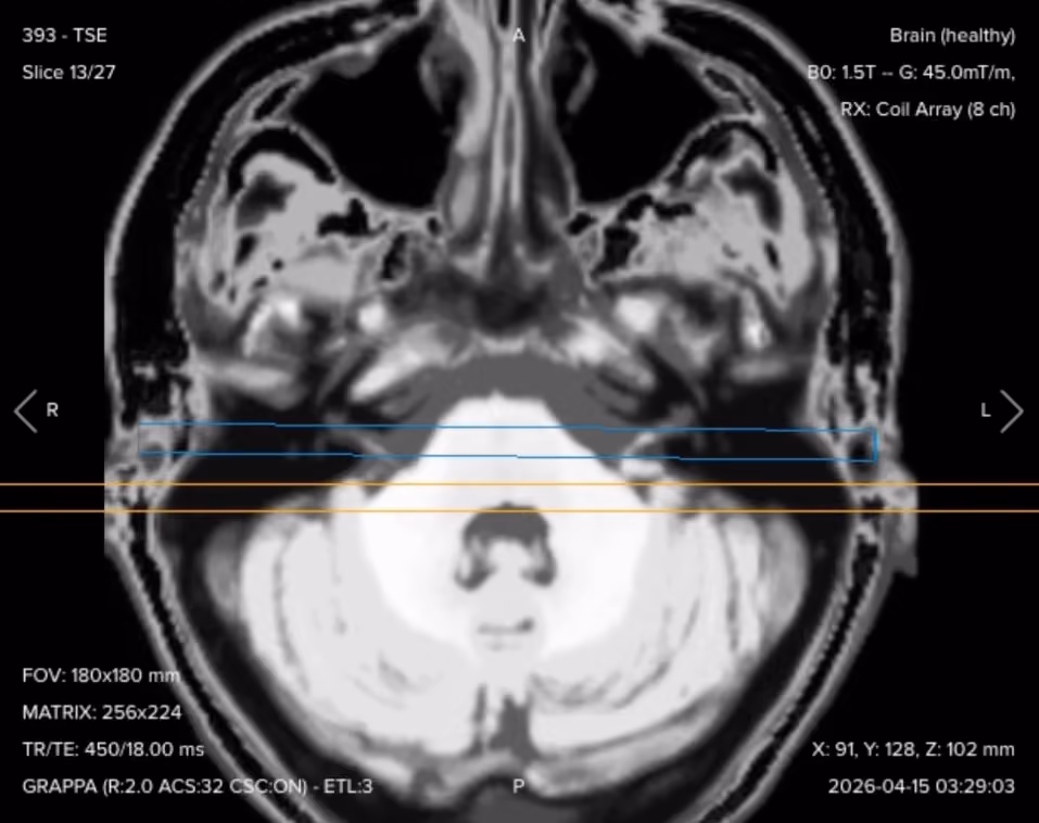 Post-contrast axial T1 fat-suppressed TSE of the internal auditory canal, showing uniform fat suppression at the skull base