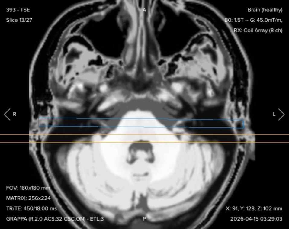 Post-contrast axial T1 fat-suppressed TSE of the internal auditory canal, showing uniform fat suppression at the skull base
