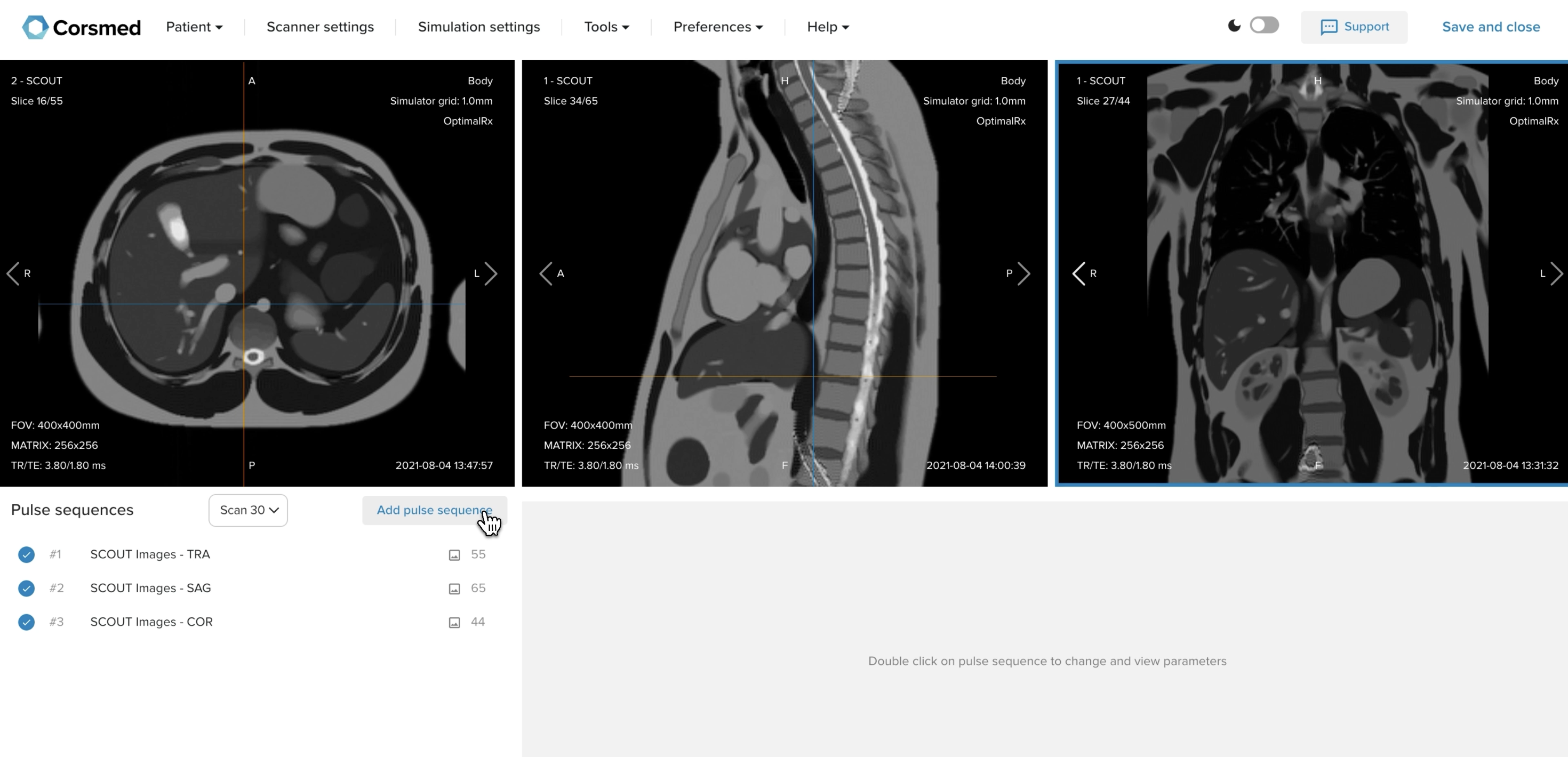 Correct setup of axial, sagittal, and coronal localizer images for an MRCP protocol in the Corsmed MRI simulator