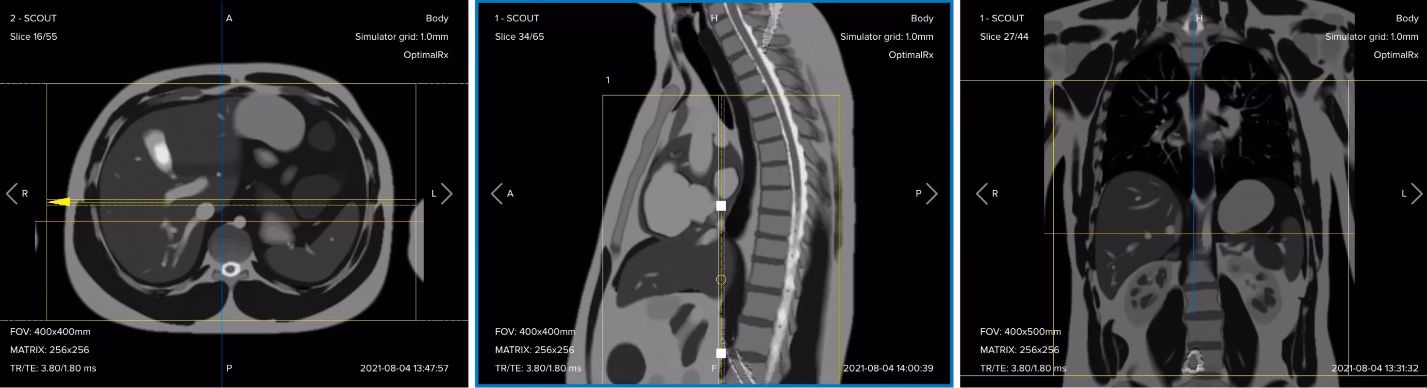 Correct planning of the coronal T2 TSE sequence for an MRCP protocol