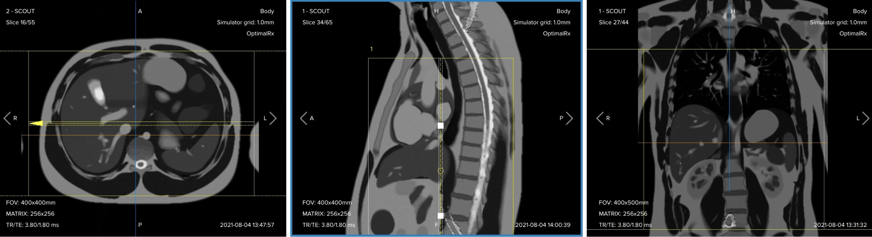 Correct planning of the coronal T2 TSE sequence for an MRCP protocol