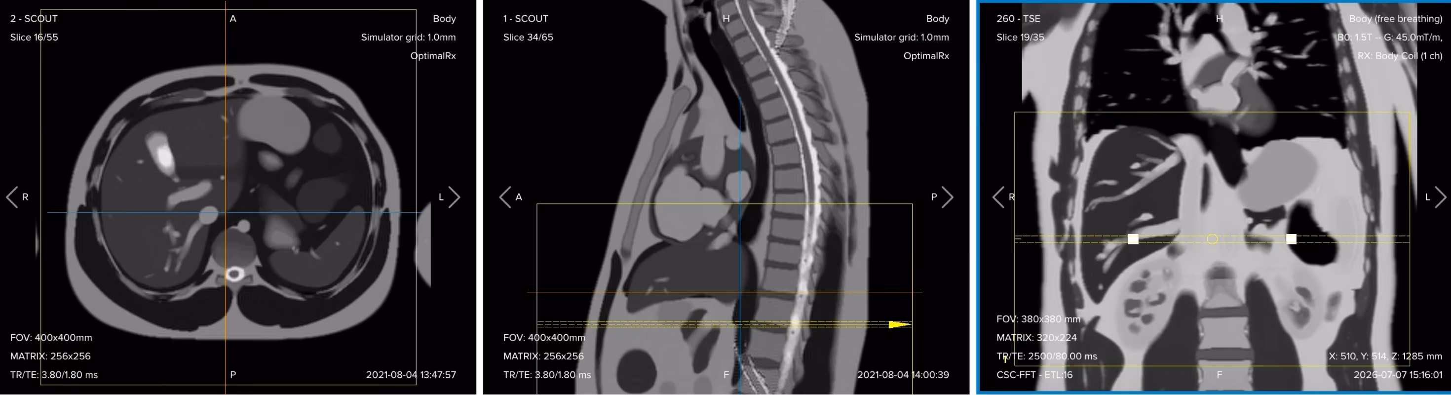 Correct planning of the axial T2 fat-suppressed turbo spin echo sequence for an MRCP protocol