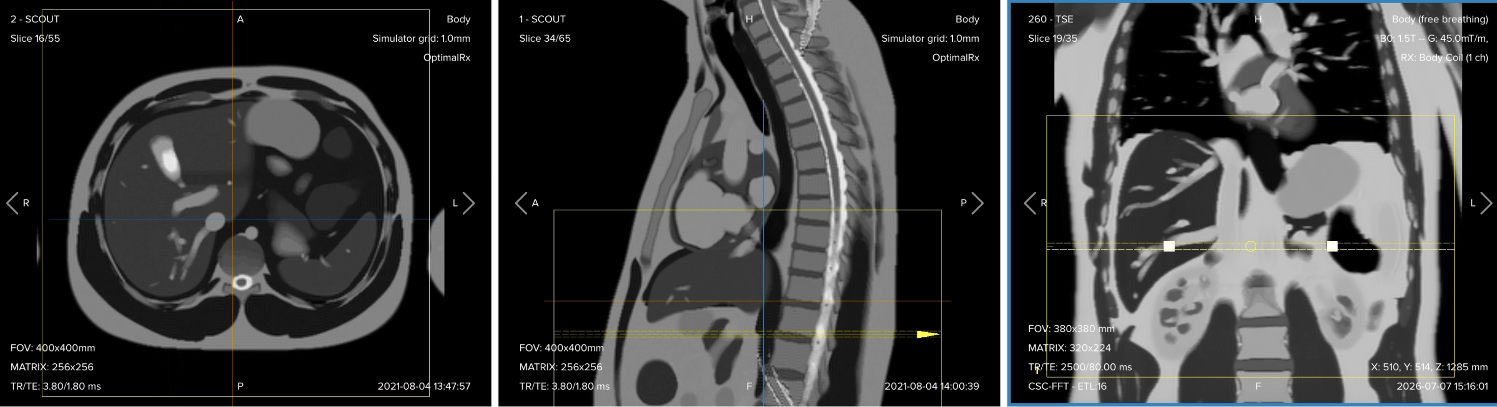 Correct planning of the axial T2 fat-suppressed turbo spin echo sequence for an MRCP protocol