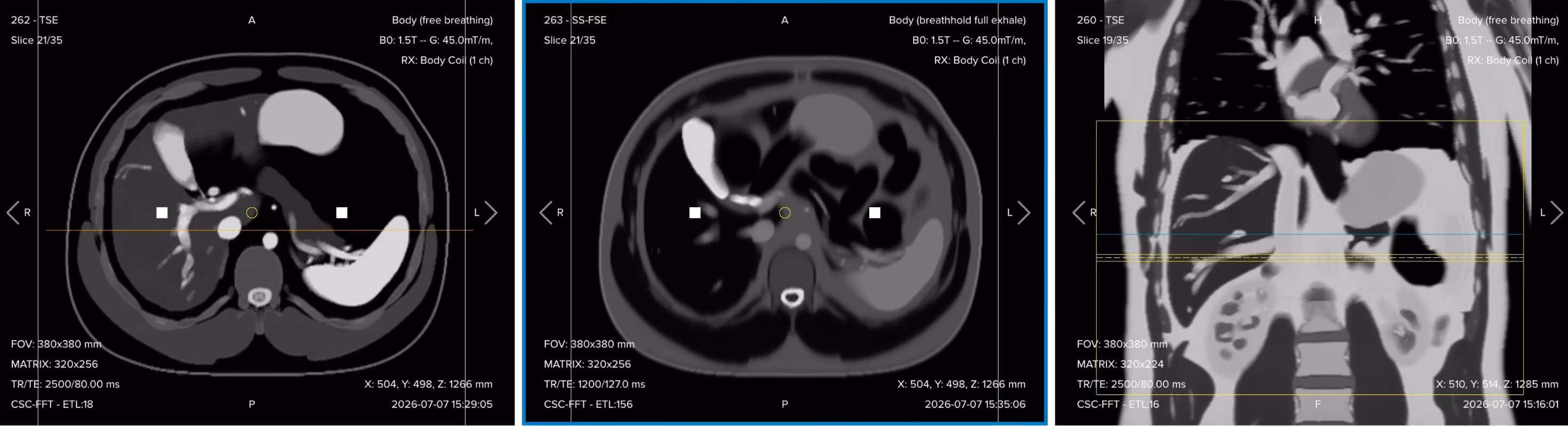 Correct planning of the axial gradient echo Dixon sequence for an MRCP protocol