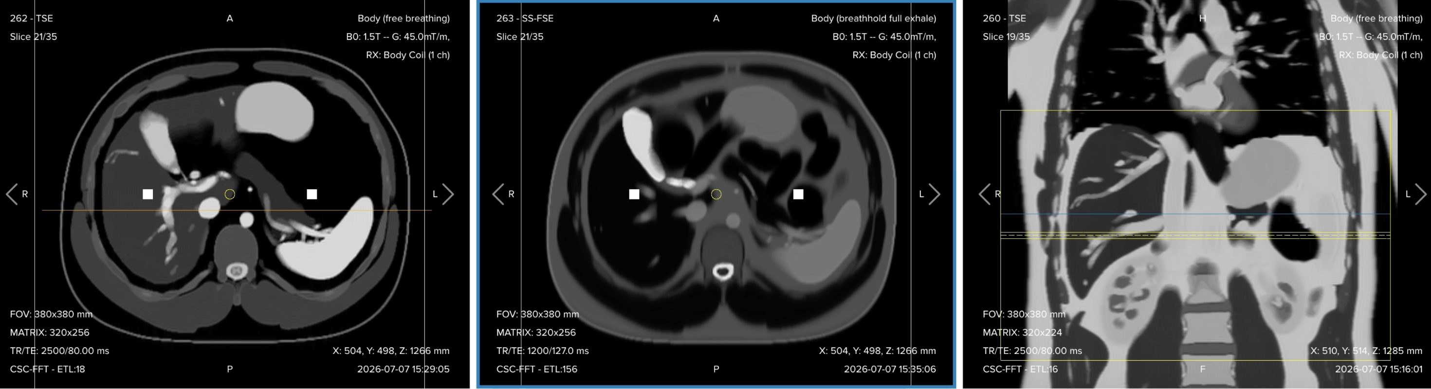 Correct planning of the axial gradient echo Dixon sequence for an MRCP protocol