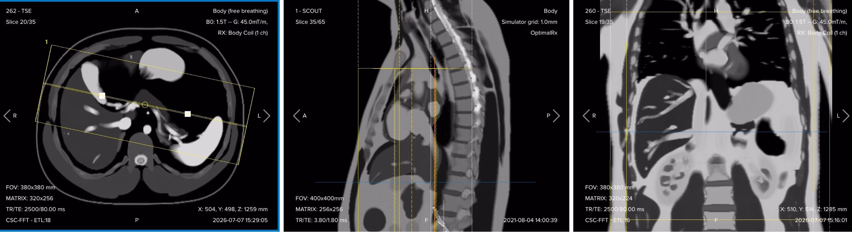 Correct planning of the 3D MRCP sequence, shown as a coronal slab positioned perpendicular on the axial view