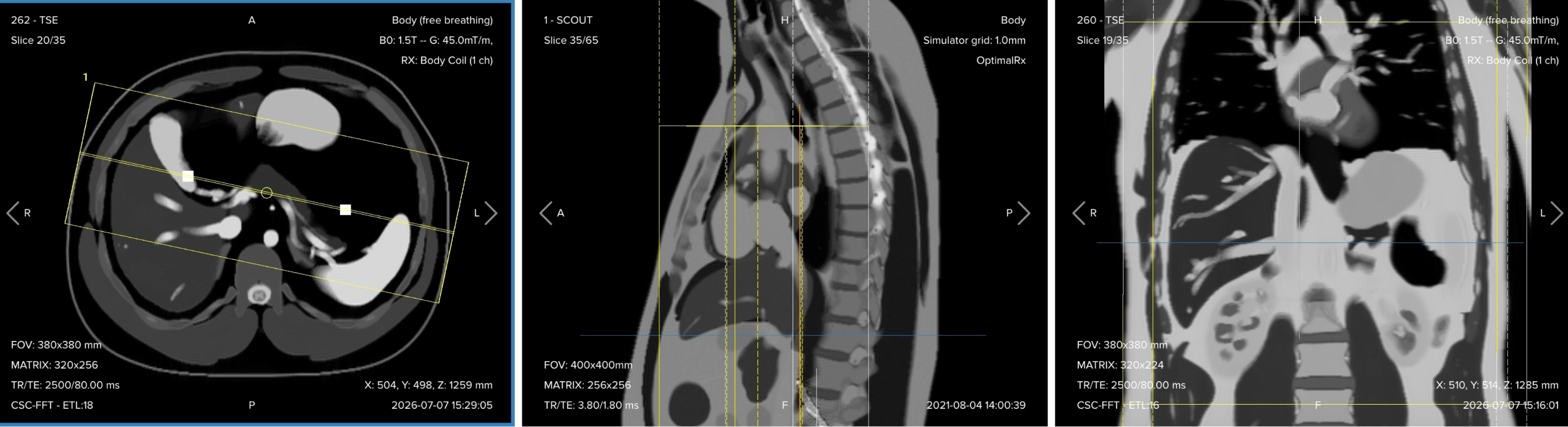 Correct planning of the 3D MRCP sequence, shown as a coronal slab positioned perpendicular on the axial view