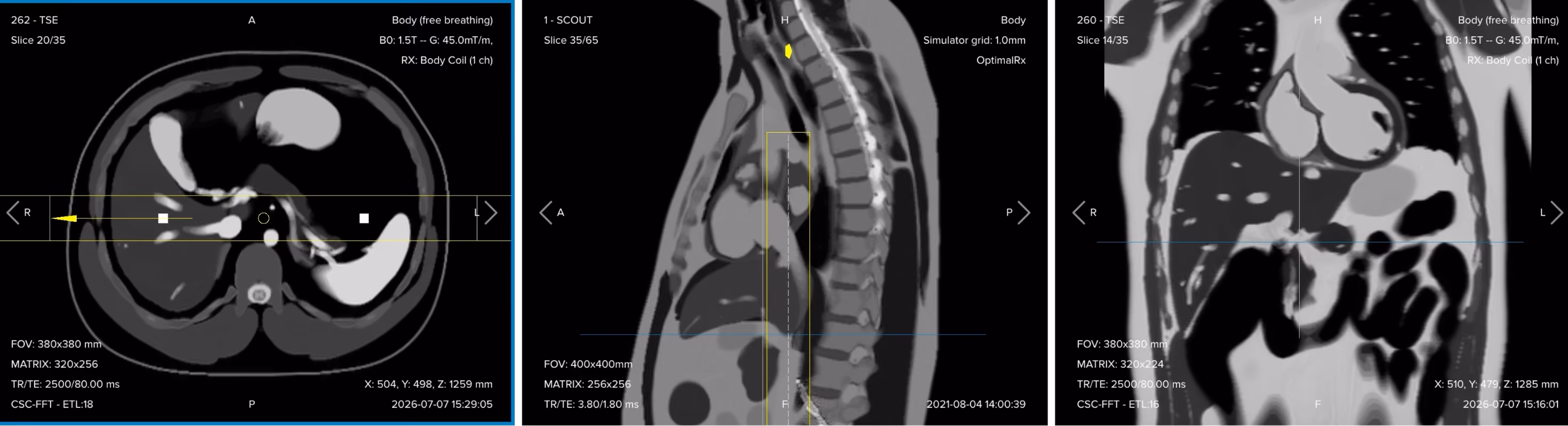Correct planning of the radial single-shot turbo spin echo fat-suppressed sequence, showing thick slab rotating around a central axis