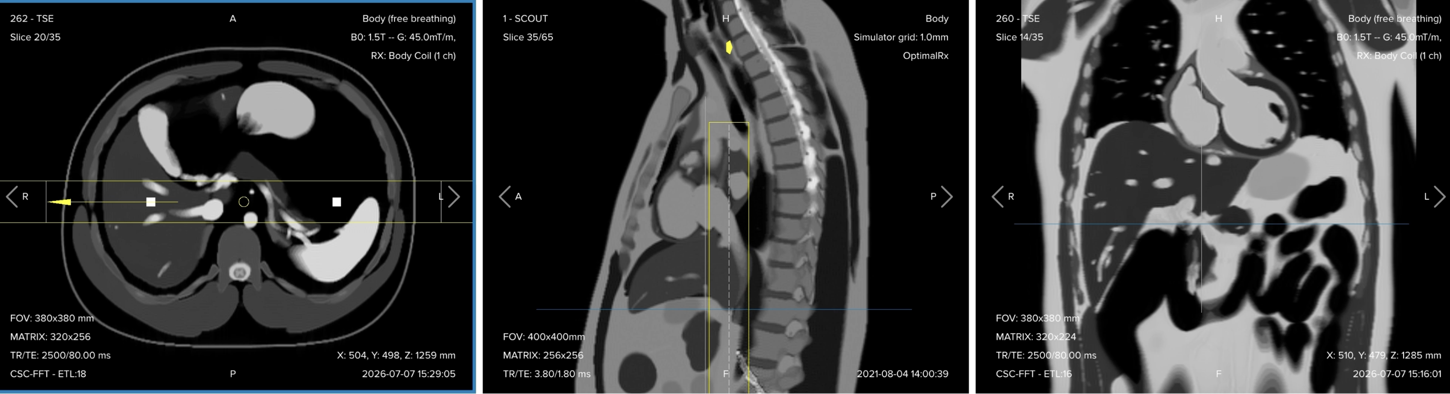 Correct planning of the radial single-shot turbo spin echo fat-suppressed sequence, showing thick slab rotating around a central axis