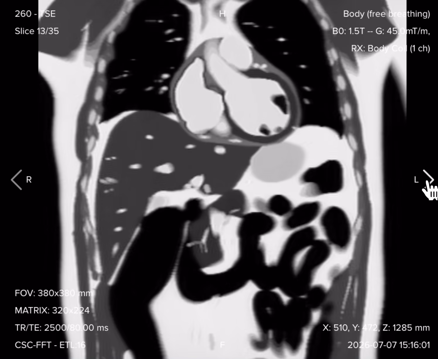 Coronal T2 TSE image of the upper abdomen showing the liver, gallbladder, pancreas, biliary tree, and spleen