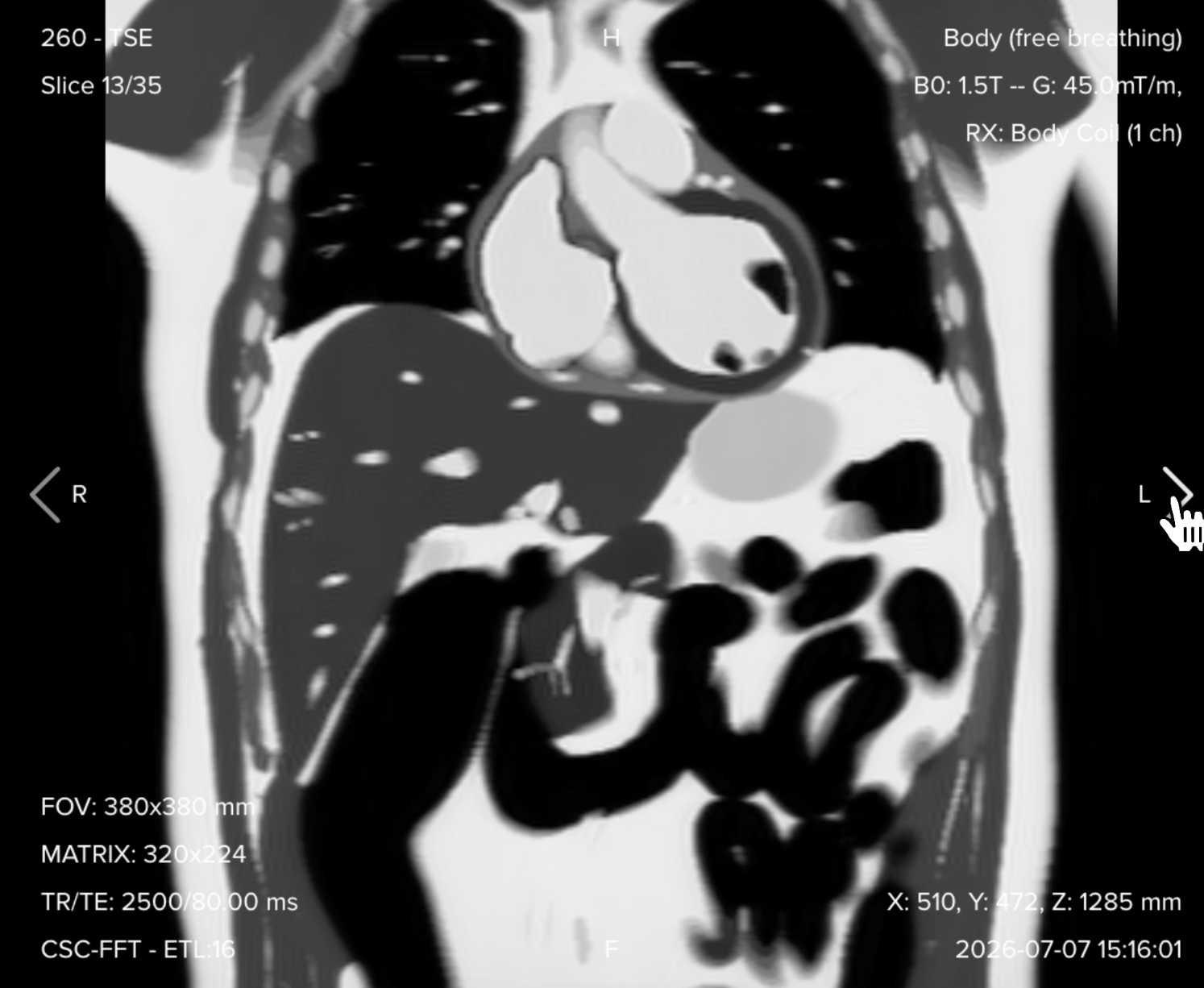 Coronal T2 TSE image of the upper abdomen showing the liver, gallbladder, pancreas, biliary tree, and spleen