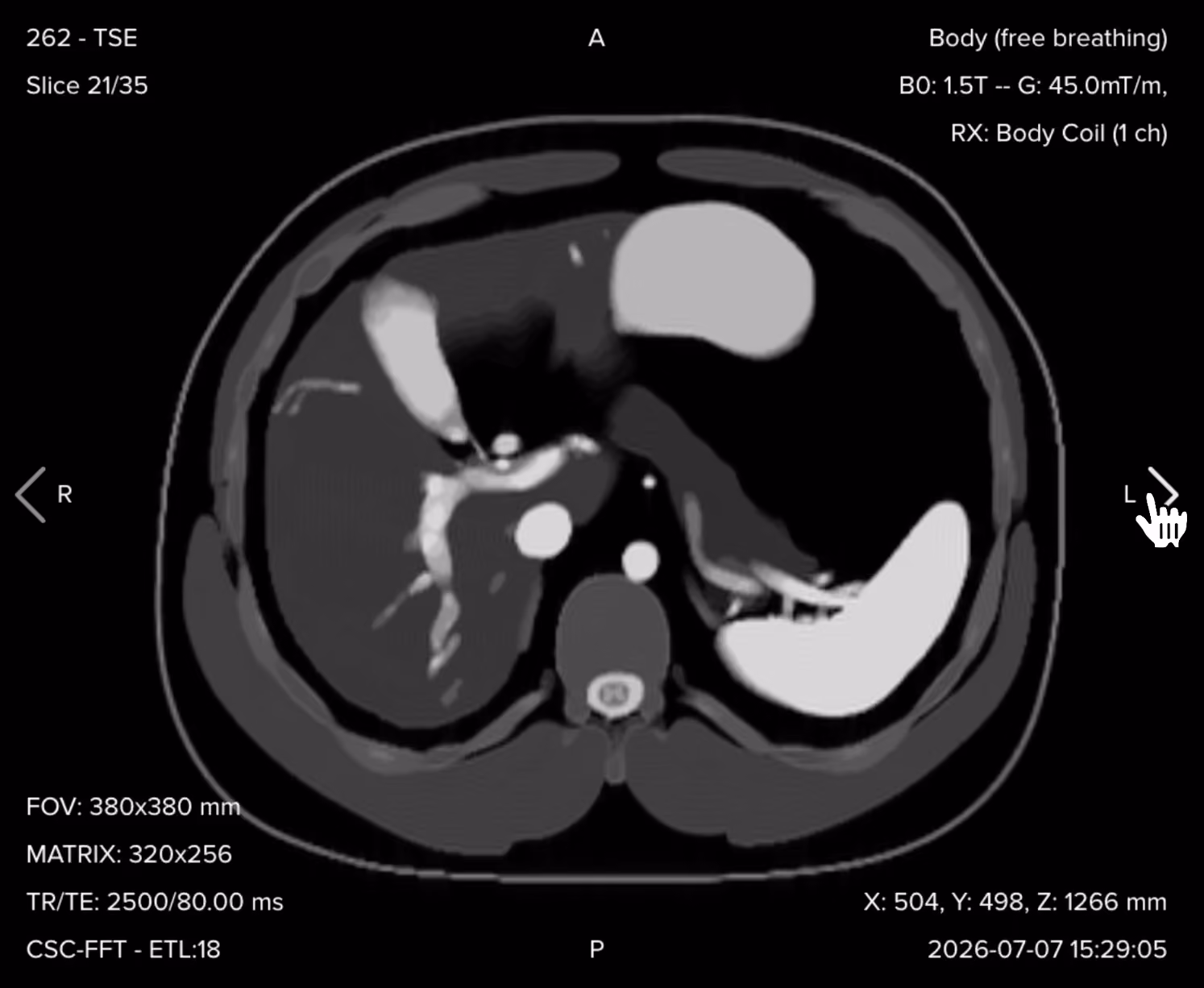 Axial T2 fat-suppressed turbo spin echo image showing suppressed fat with bright fluid and edema in the upper abdomen