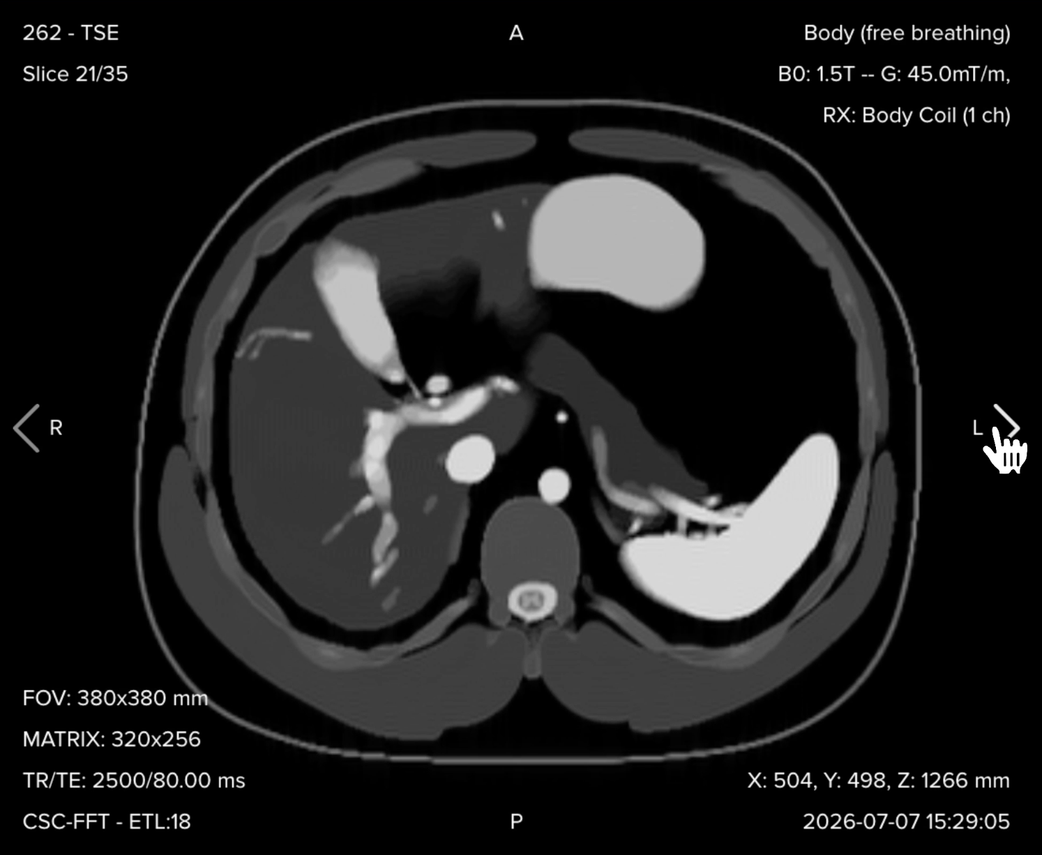 Axial T2 fat-suppressed turbo spin echo image showing suppressed fat with bright fluid and edema in the upper abdomen