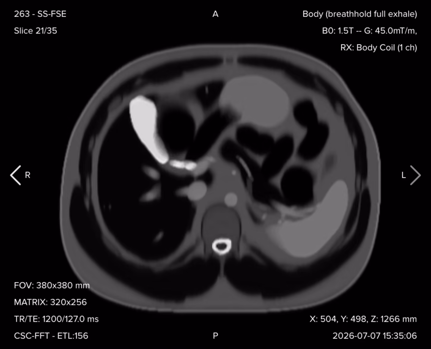 Axial T2 single-shot turbo spin echo image of the upper abdomen showing bright fluid and well-defined vital structures