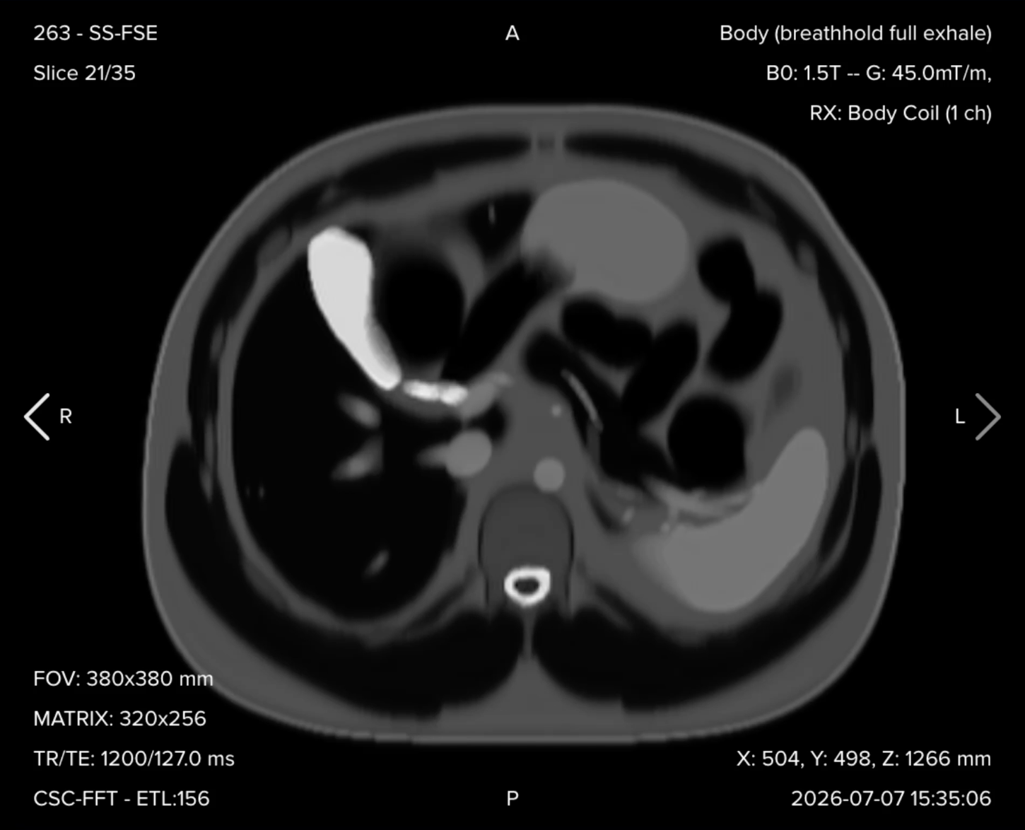 Axial T2 single-shot turbo spin echo image of the upper abdomen showing bright fluid and well-defined vital structures