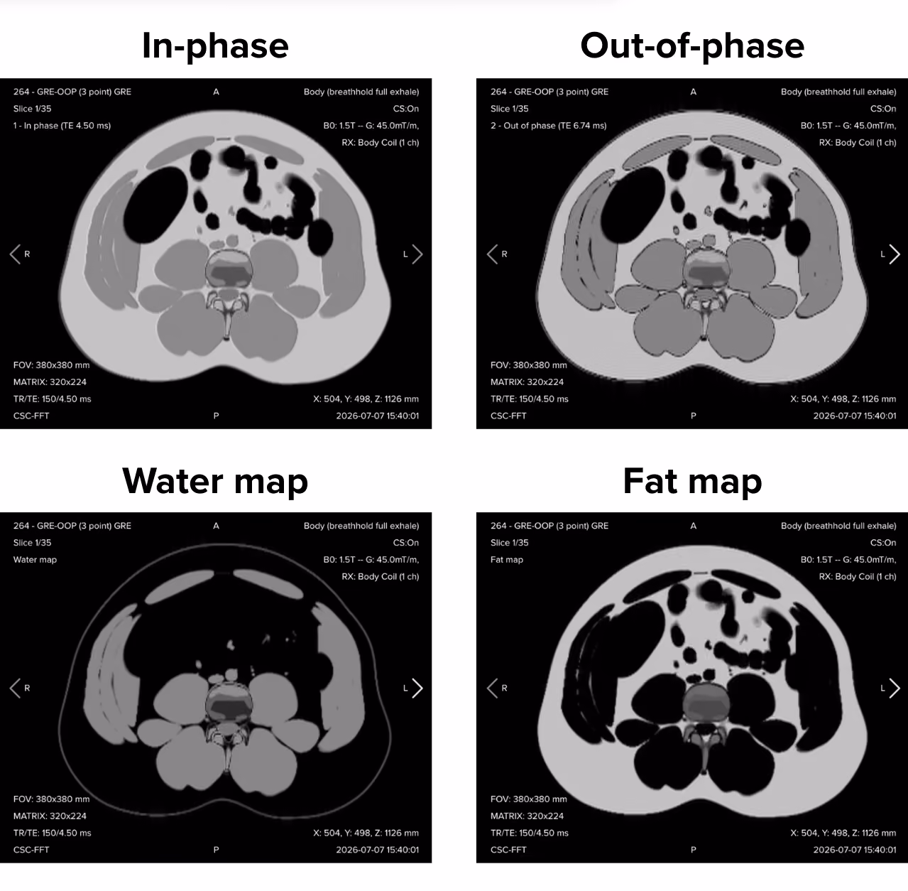 The four reconstructions of an axial gradient echo Dixon acquisition: in-phase, out-of-phase, water-only, and fat-only images of the upper abdomen