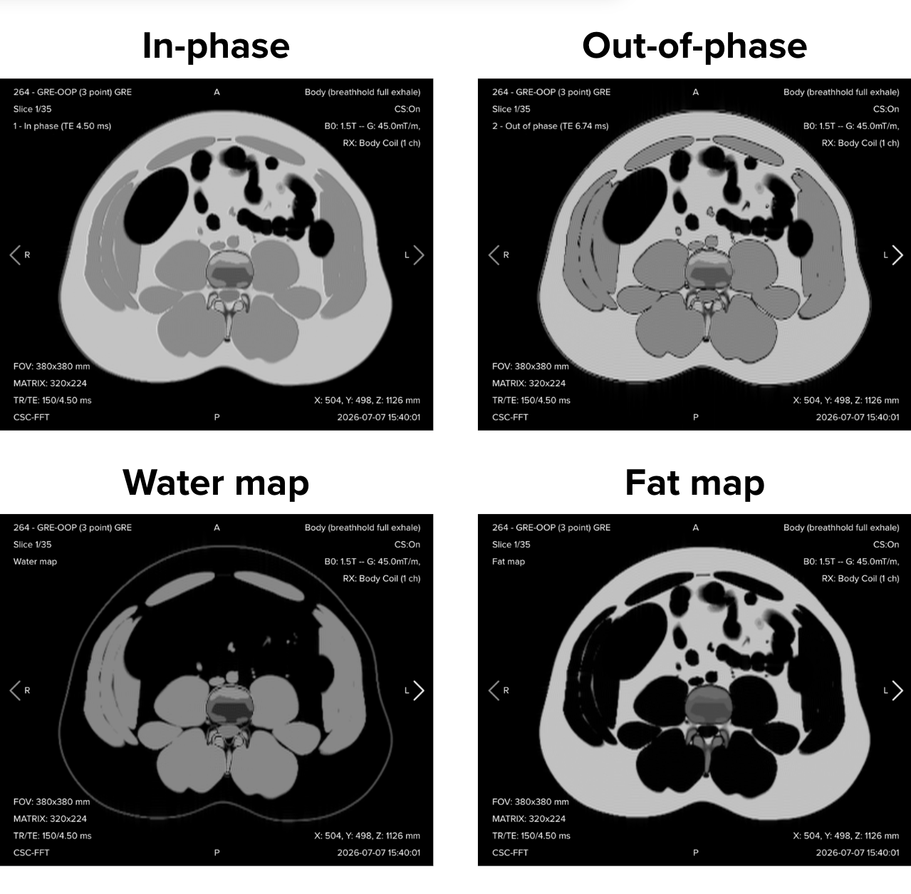 The four reconstructions of an axial gradient echo Dixon acquisition: in-phase, out-of-phase, water-only, and fat-only images of the upper abdomen
