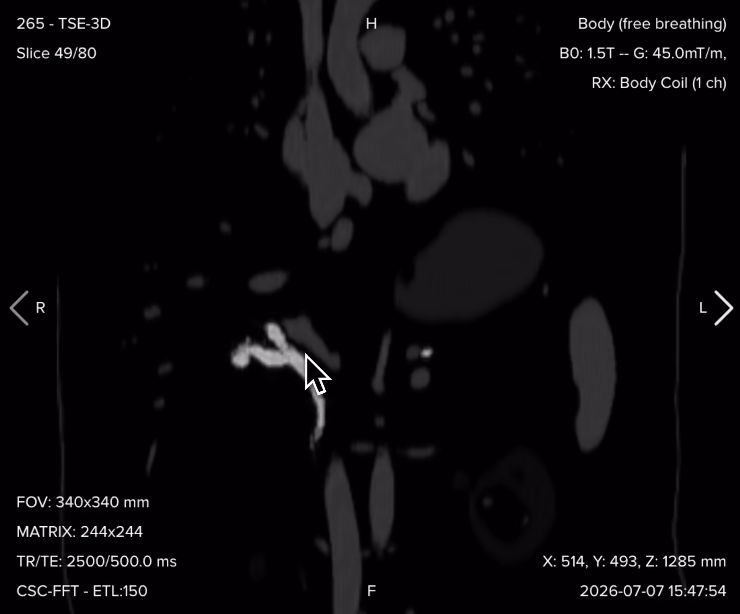 3D MRCP source image and maximum intensity projection reconstruction showing the full biliary and pancreatic duct tree