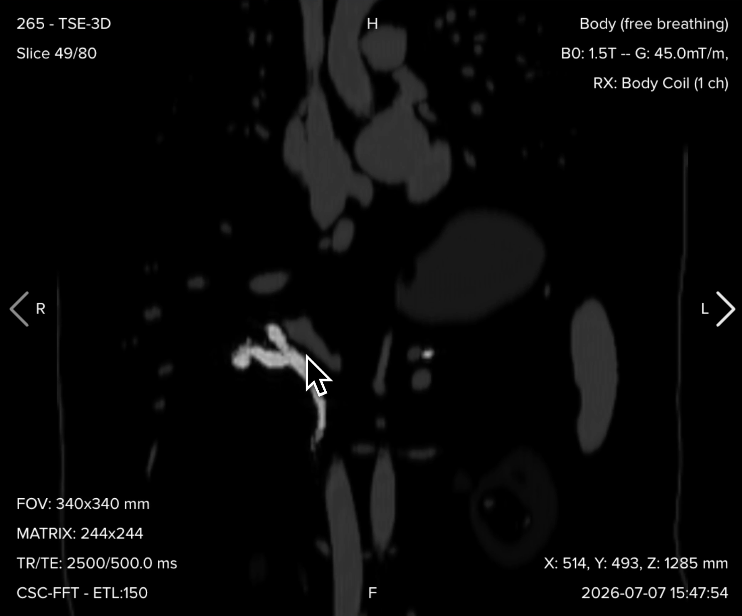 3D MRCP source image and maximum intensity projection reconstruction showing the full biliary and pancreatic duct tree
