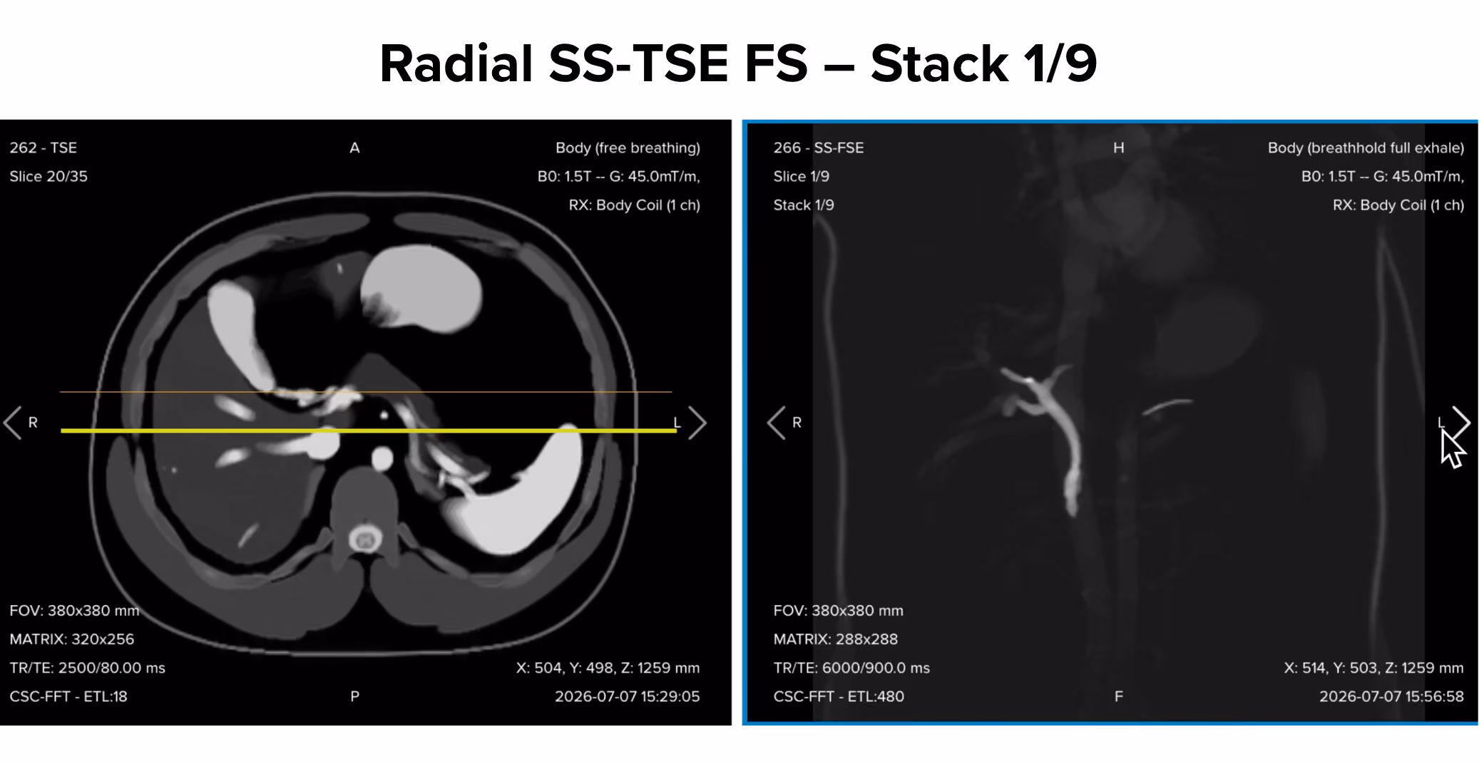 Radial single-shot turbo spin echo fat-suppressed thick-slab image, stack 1/9