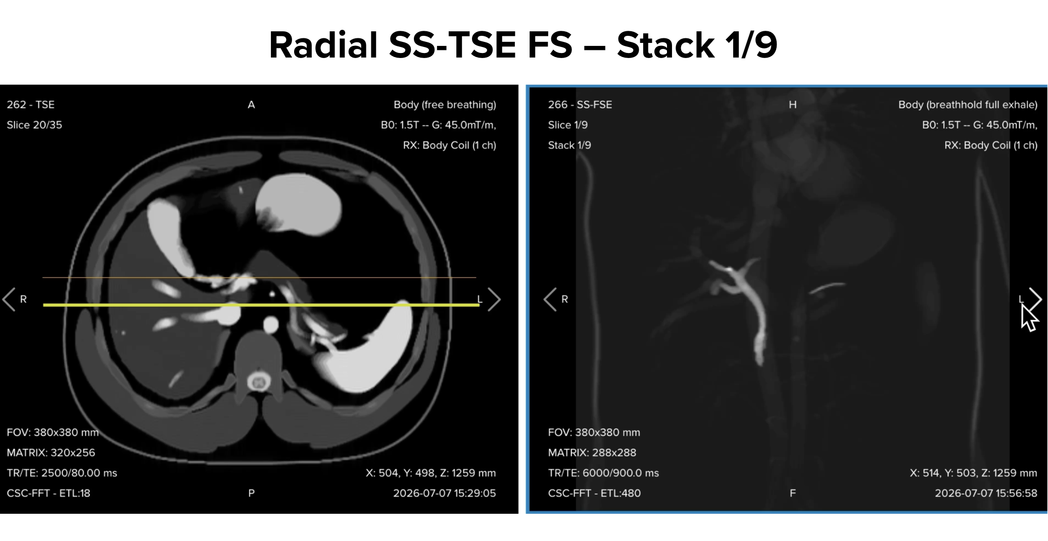 Radial single-shot turbo spin echo fat-suppressed thick-slab image, slice 1/9