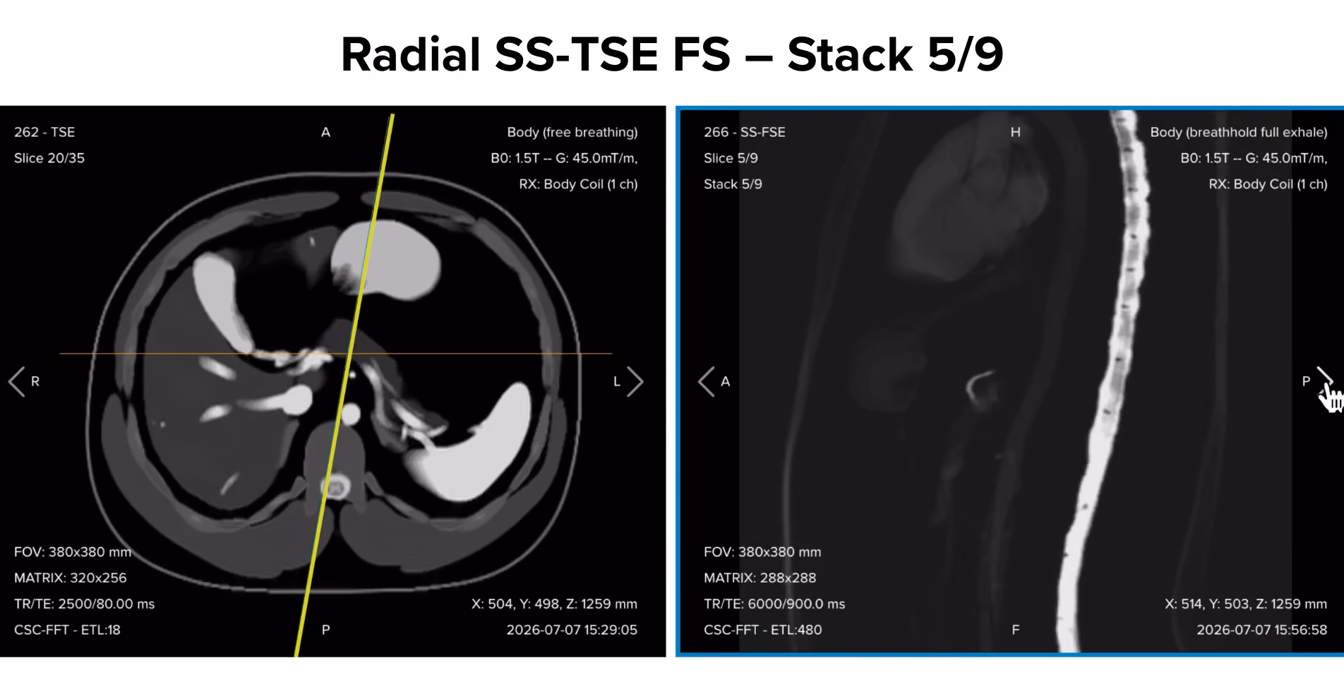 Radial single-shot turbo spin echo fat-suppressed thick-slab image, stack 5/9