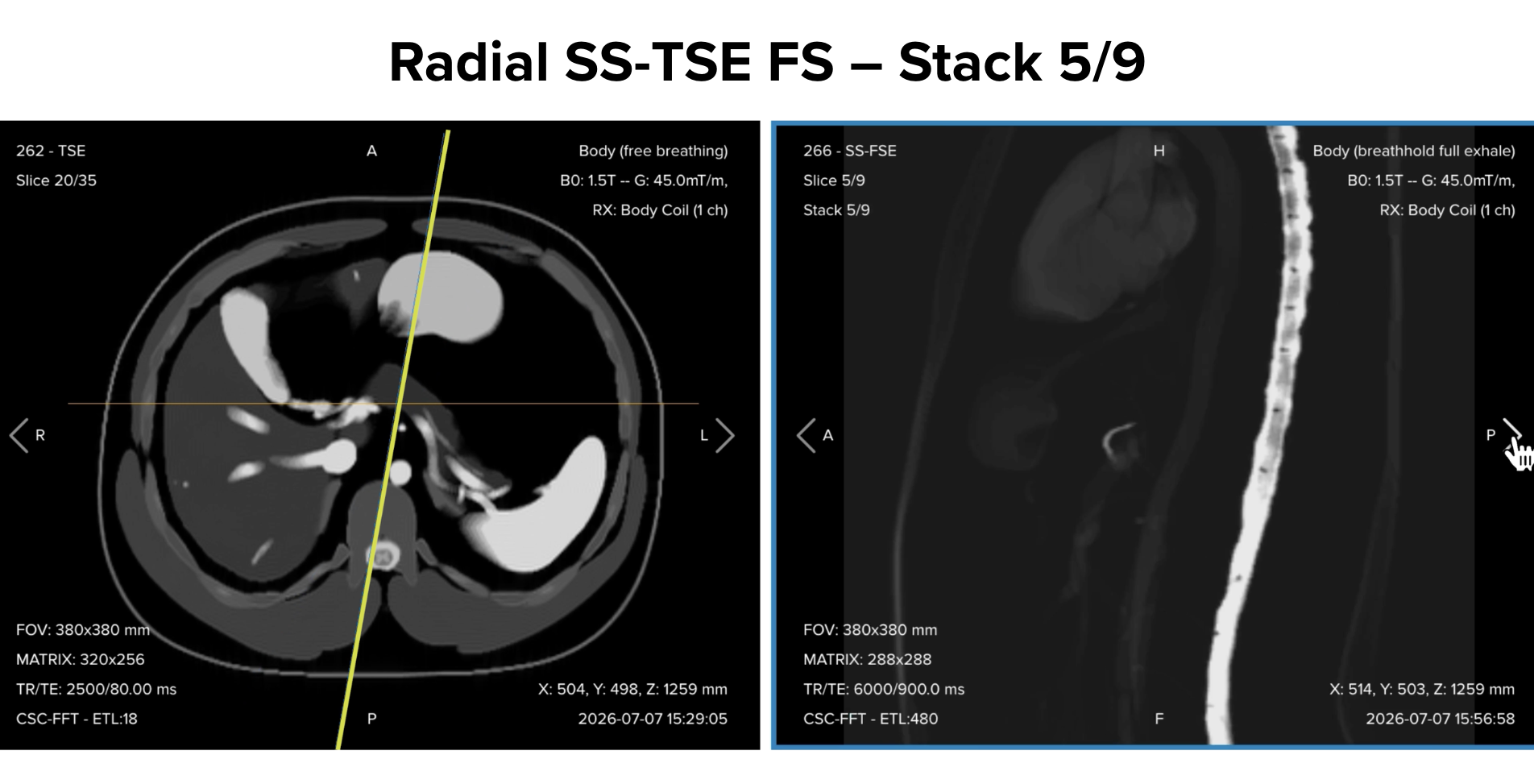 Radial single-shot turbo spin echo fat-suppressed thick-slab image, slice 5/9