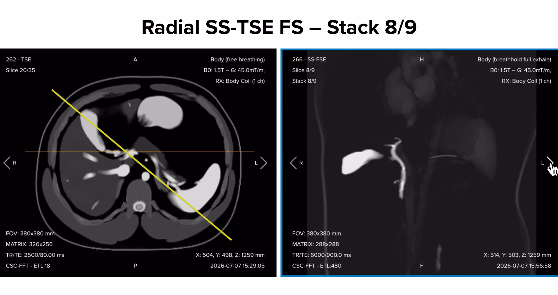 Radial single-shot turbo spin echo fat-suppressed thick-slab image, stack 8/9