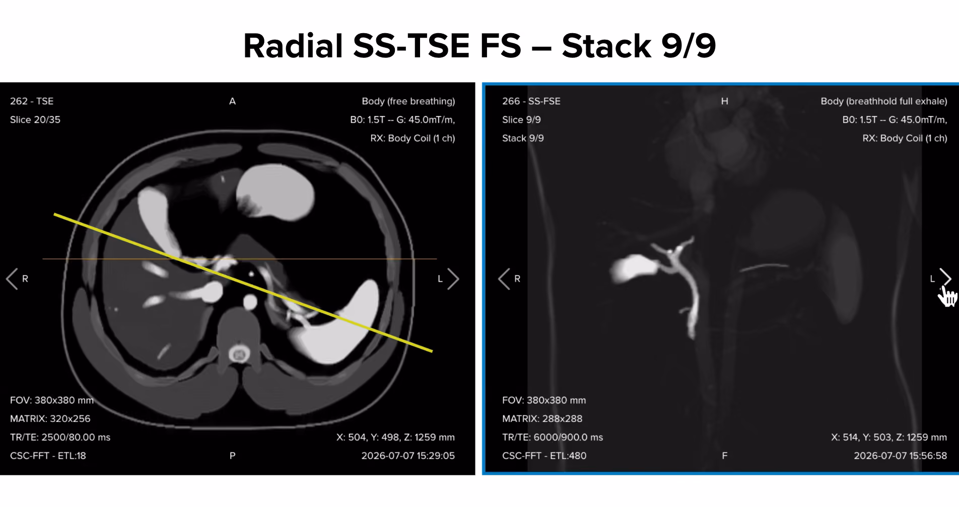 Radial single-shot turbo spin echo fat-suppressed thick-slab image, stack 9/9