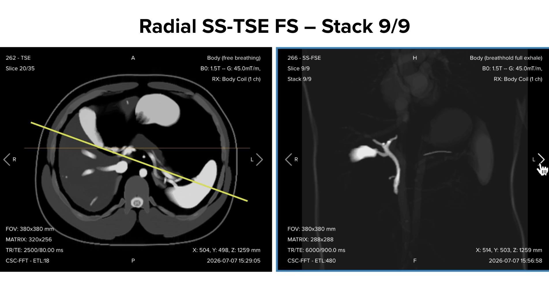 Radial single-shot turbo spin echo fat-suppressed thick-slab image, slice 9/9