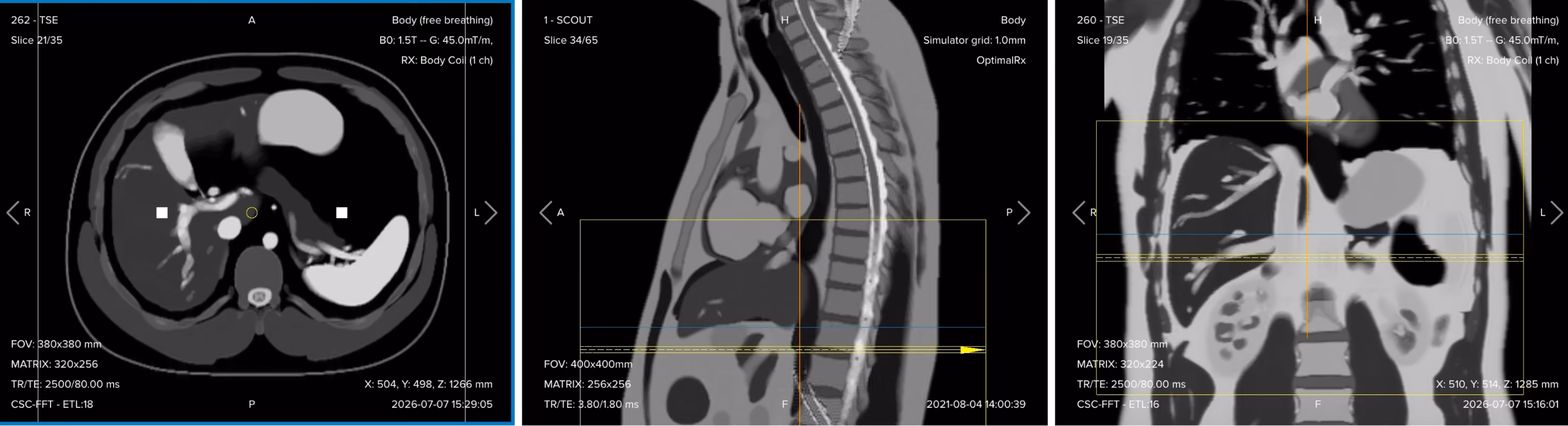 Correct planning of the axial T2 single-shot turbo spin echo sequence for an MRCP protocol
