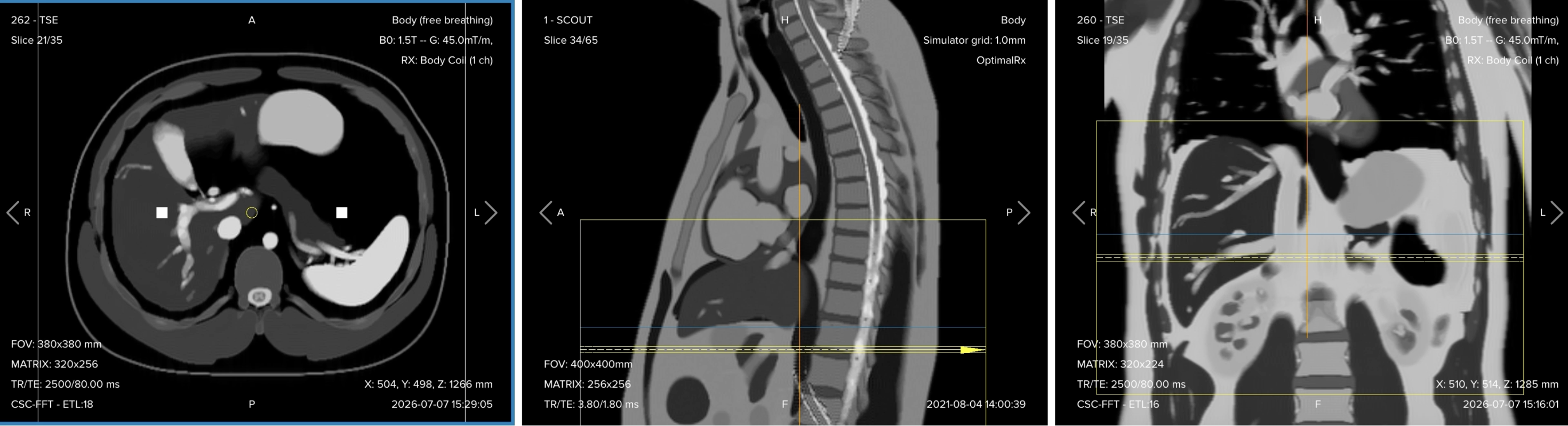 Correct planning of the axial T2 single-shot turbo spin echo sequence for an MRCP protocol