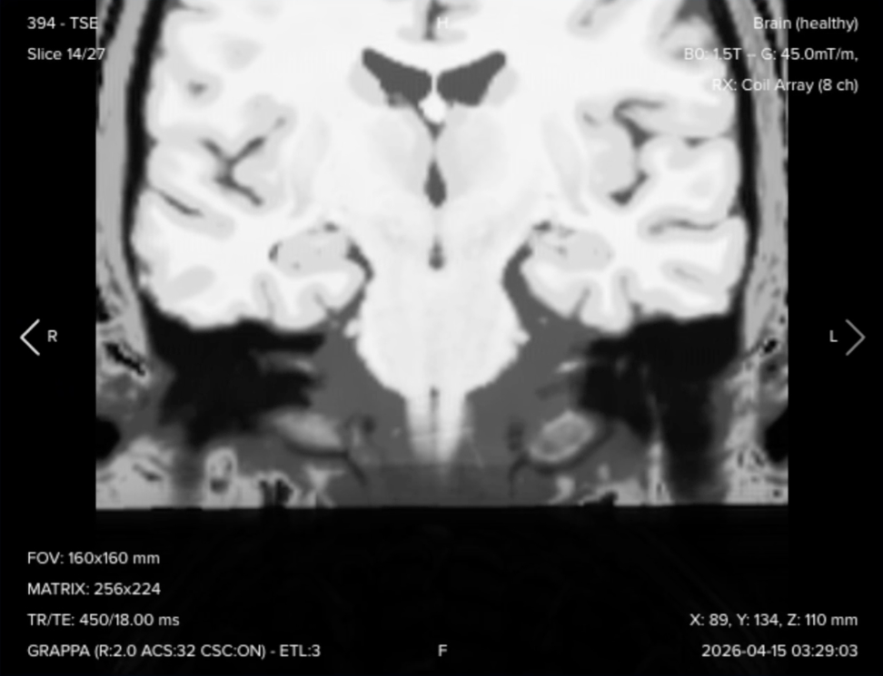Post-contrast coronal T1 fat-suppressed TSE of the internal auditory canal, showing uniform fat suppression across the skull base.