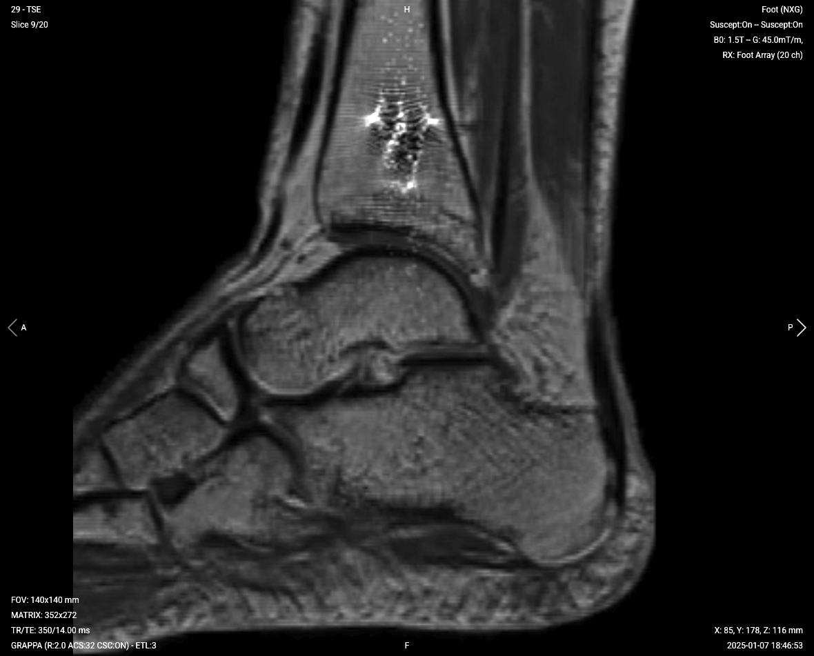 Sagittal T1 TSE of ankle with metal implant – Correct Image Example