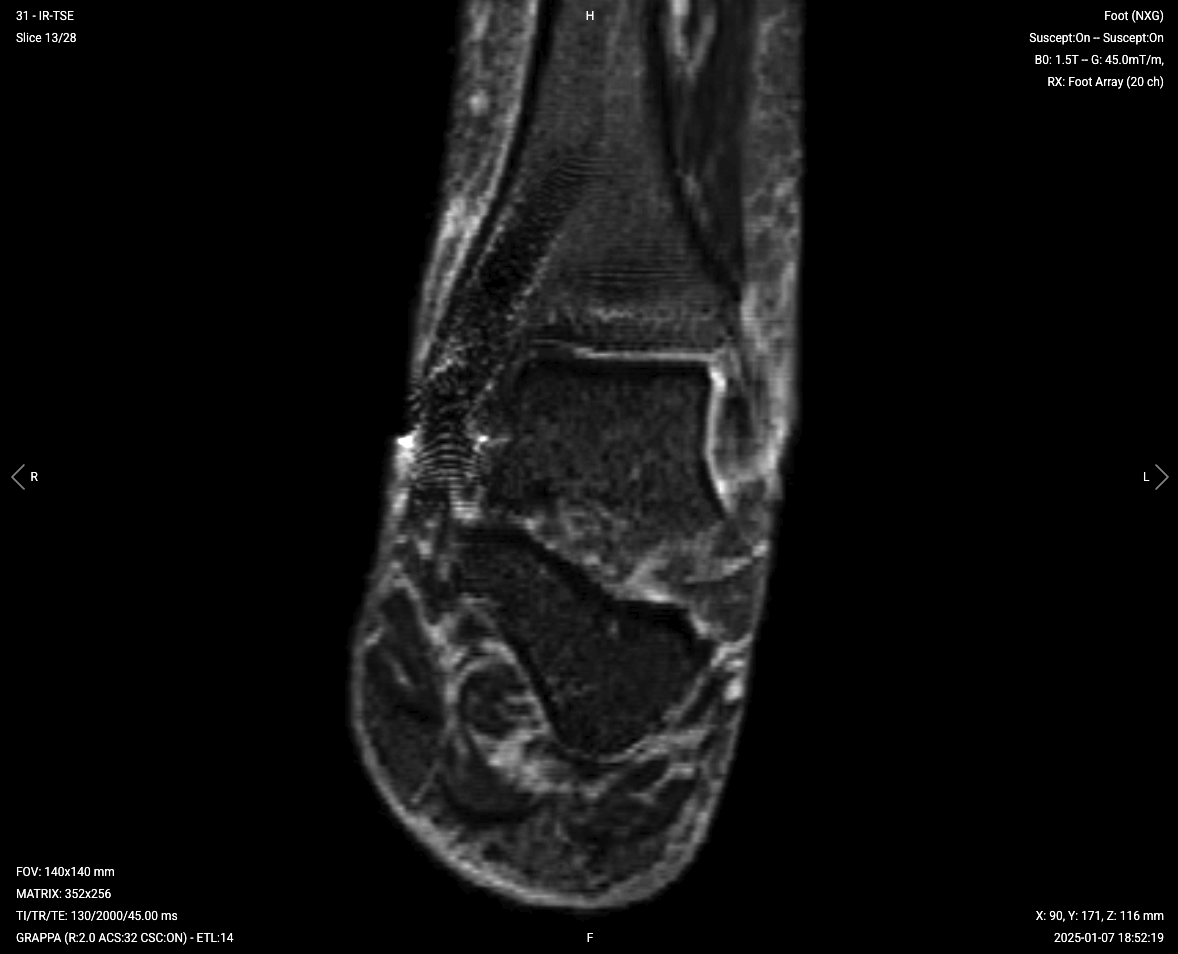 Coronal PD STIR of ankle with metal implant – Correct Image Example